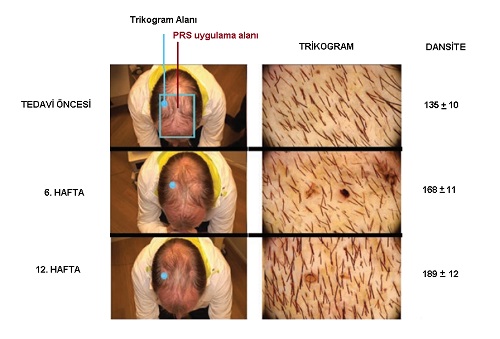 Kadın ve Erkekte Erkek Tipi Saç Dökülmesinde, Androgenetik Alopesi AGA, PRP ve SVF Tedavisi 