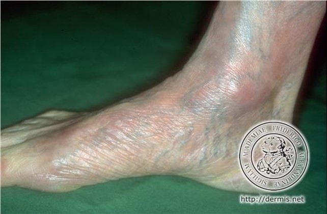 Acrodermatitis-chronica-atrophicans.jpg