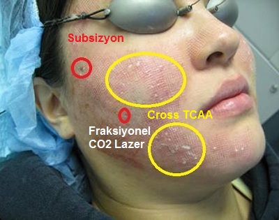 Akne-izleri-akne-skar-kombine-tedaviler-subsizyonfralsiyonel-CO2-lazer-cross-tcaa-2.jpg