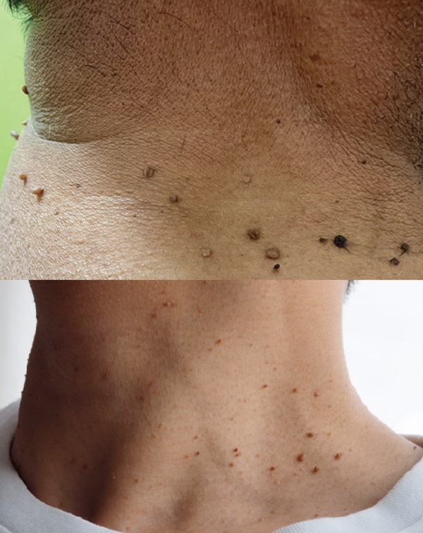 Akrokordon_Skin_Tag_Deri_polipleri_boyunda_et_benleri.jpg
