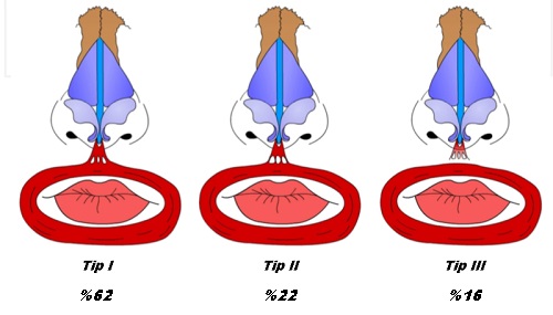 Botox-ile-burun-estetigi-2.jpg