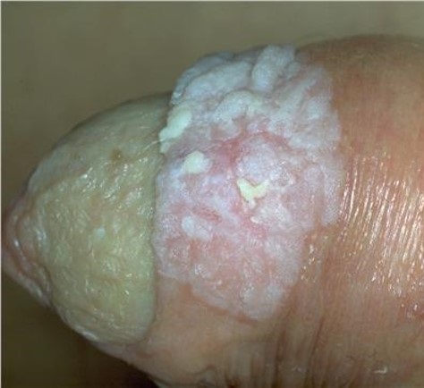 Bowenoid-papulosis.jpg