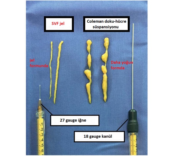 Yağ Enjeksiyonları SVF Jel 