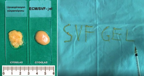 Yağ Dokusu Kaynaklı Hücre Dışı Matrix/Stromal Vasküler Fraksiyon, ECF/ADSC jel