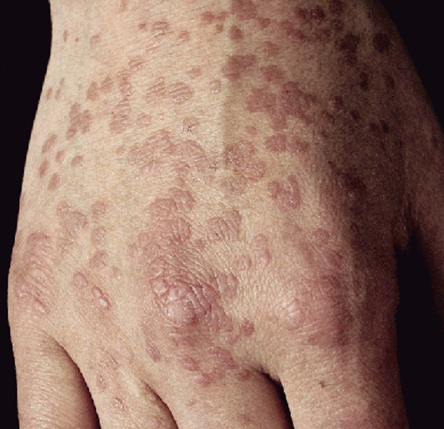 Epidermodisplazya--Verrsiformis.jpg