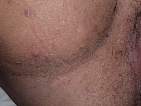 Hidradenitis_Supurativakopek_memesi_hastaligi_papuller.jpg