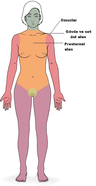 Keloidal-alanlar.jpg