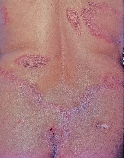 Lepra-Czzam-Hansen-Hastal-Borderline-Tberkloid-lepra.jpg