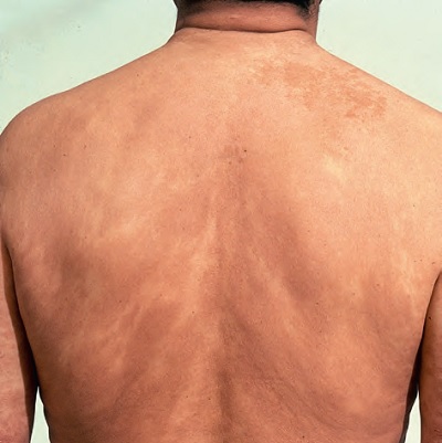 Lepra-Czzam-Hansen-Hastal-Lepramatz-lepra-.jpg