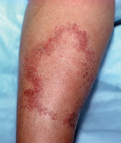 Lepra-Czzam-Hansen-Hastal-Tberkloid-lepra.jpg