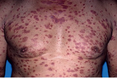 Lepra-Czzam-Hansen-Hastal-Tip-1-reaksiyon-.jpg