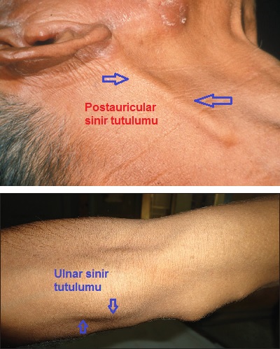 Lepra-Czzam-Hansen-Hastal-sinir-tutulumu.jpg
