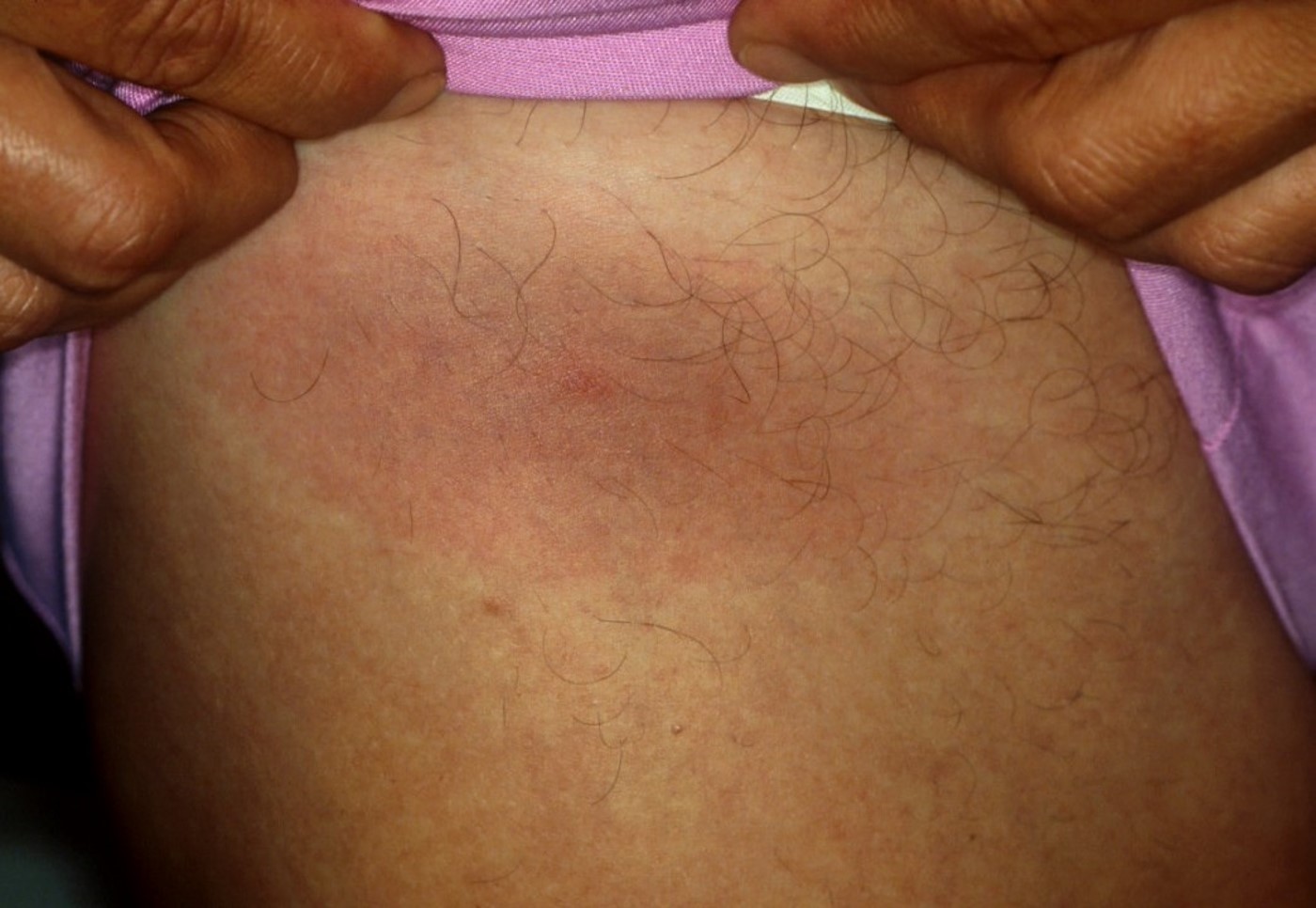 Lyme-hastaligi-3.jpg