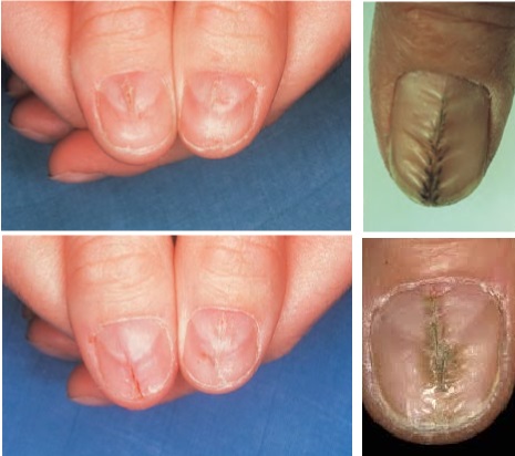 Median-nail-deformitesi.jpg