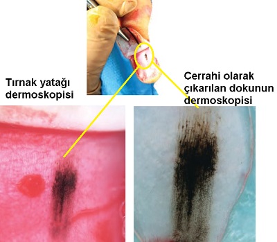 Melanonisi-tirnak-cerrahisi-sirasinda-dermoskopi.jpg
