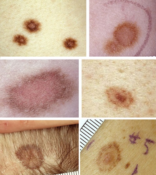 Melanositik-nevs-eklips-tipi.jpg