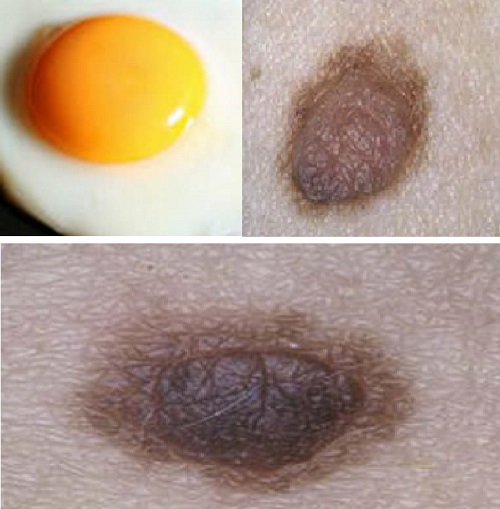 Melanositik-nevs-sahan-yumurta-fried-egg-tipi.jpg