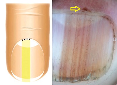 Mikro-Hutchinson-bulgusu-melanoma-dermoskopi.jpg