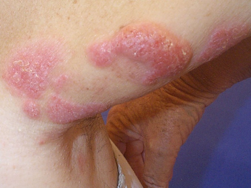 Mycosis-Fungoides.-2.jpg