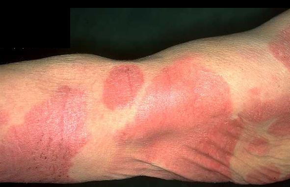 Mycosis-Fungoides4.jpg