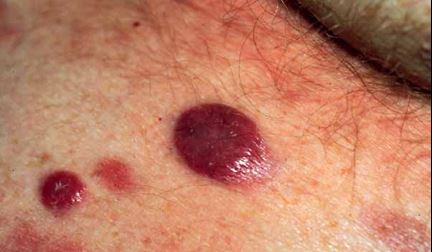 Mycosis-Fungoides5.jpg