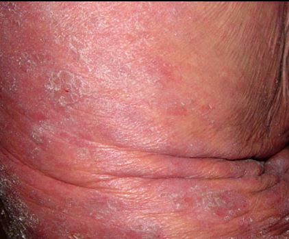 Mycosis-Fungoides6.jpg