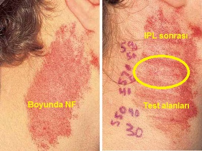 Porto-Sarab-Lekesi-Port-Wein-Stain-Nevus-Flammeus-Lazer-12.jpg