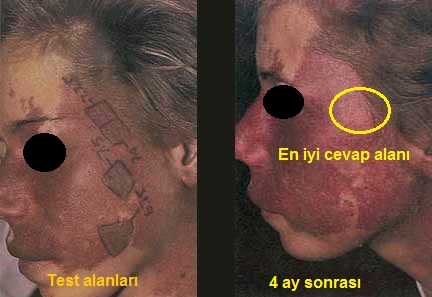 Porto-Sarab-Lekesi-Port-Wein-Stain-Nevus-Flammeus-Lazer-13.jpg