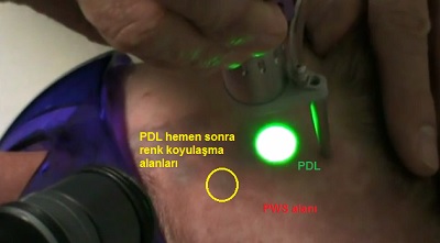 Porto-Sarab-Lekesi-Port-Wein-Stain-Nevus-Flammeus-Lazer-8.jpg