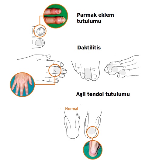 Sedef-eklem-tutulumu-4.jpg