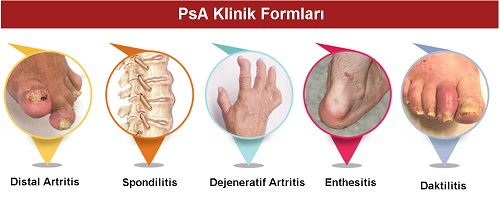 Sedef-eklem-tutulumu-9.jpg