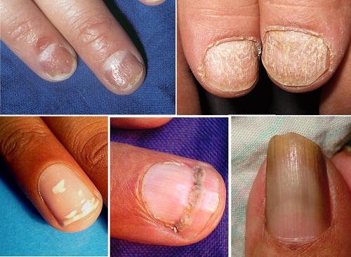 Sedef-hastalnda-trnak-tutulumu-1.jpg