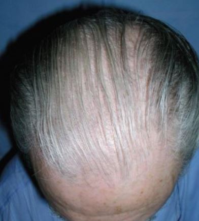 Senil-alopesi.jpg