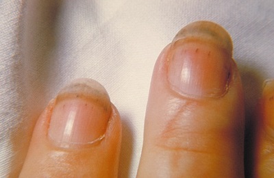 Tirnak-kil-kurdu-trichiasis.jpg