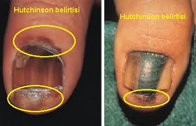 Tirnak-melanoma-Hutchinson-belirtisi.jpg