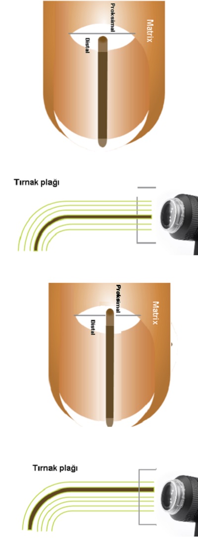 Tirnak-uc-dermoskopisi-melanonii.jpg