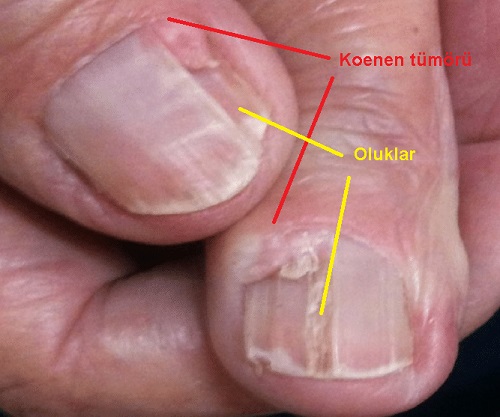 Tirnak-zerinde-oluklar-koenen-tumor.jpg