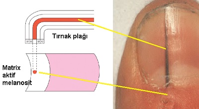 Tirnakta-aktif-melanosit-ve-melanonisi.jpg