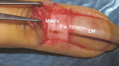 Tirnakta-melanonisi.jpg