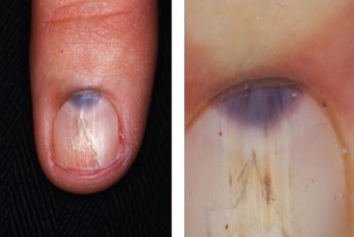 Tirrnakta-Mavi-Ben-Tirnakta-Blue-Nevus.jpg