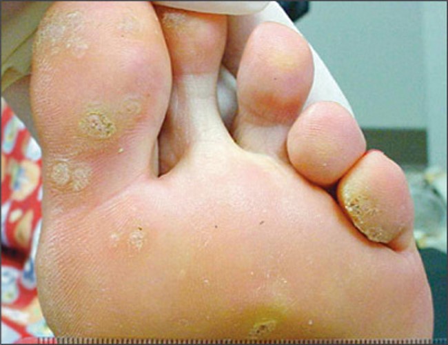 Verruka-plantaris-2.jpg