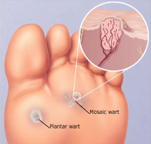 Verruka-plantaris.jpg