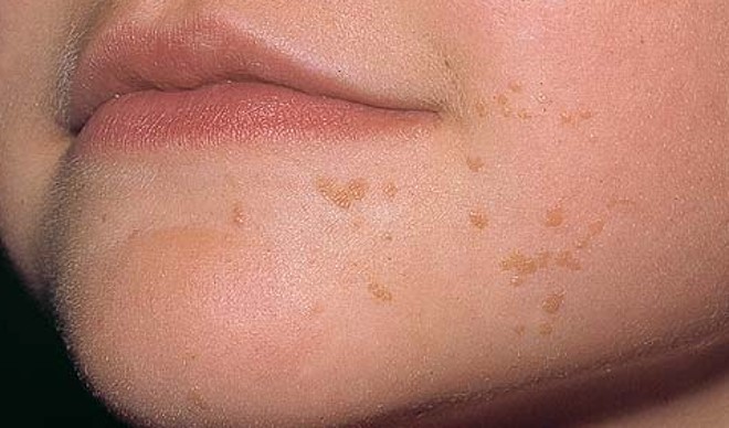 Verruka-planus.jpg