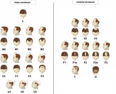 Erkeke tipi saç dökülmesinde Patern Sınıflandırma