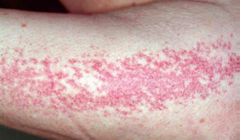 angioma_serpiginosum_01.jpg