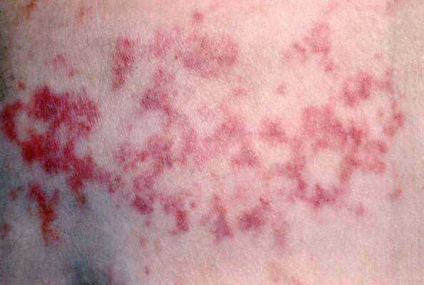 angioma_serpiginosum_03.jpg