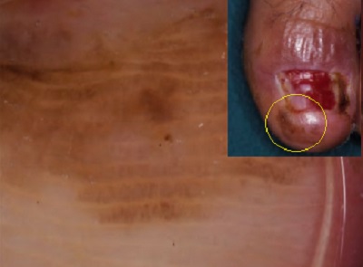 atipik-Hutchinson-bulgusu-melanoma-dermoskopi.jpg