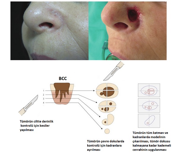 bazal_hcreli_karsinoma_BCC_cerrahi_tedavisi.jpg
