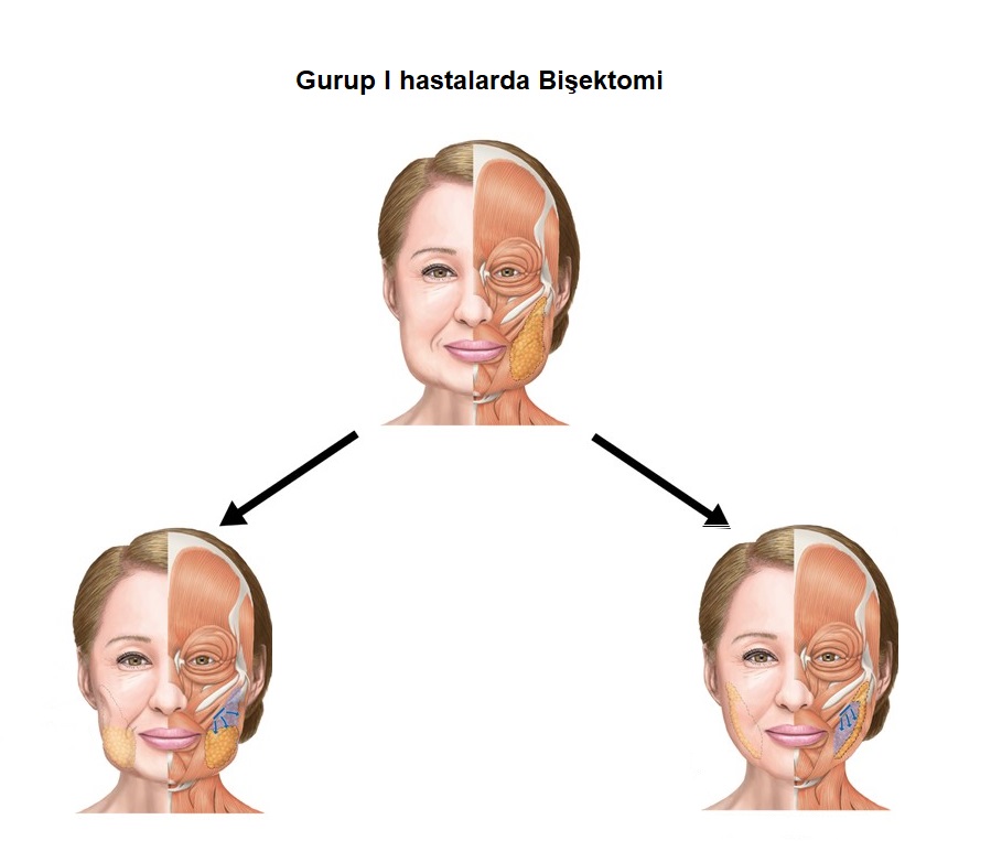 buccal_fat_pad_bukkal_yag_pedi_bisektomi_teknikleri_1.jpg