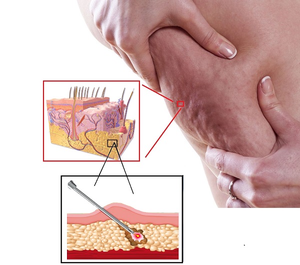 Selülit ve Tedavisi, Lazer Lipolizis